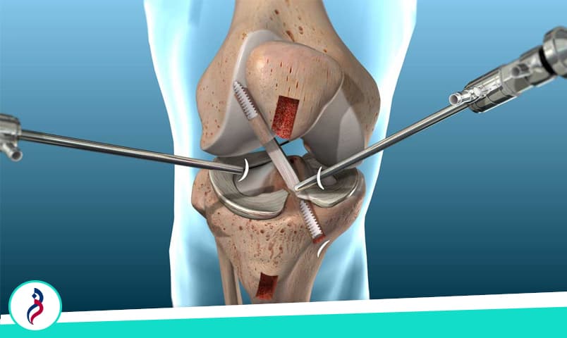 آسیب رباط صلیبی قدامی (ACL)