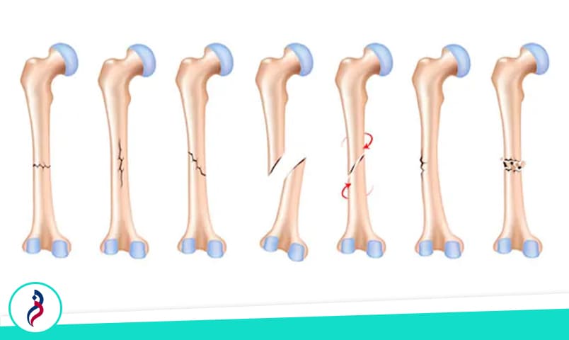 شکستگی چیست؟
